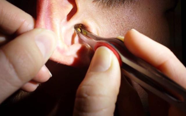 耳朵的耳屎很多到底要不要掏?医生告诉你处理耳屎的正确做法
