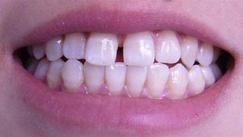 牙齿缝隙大有什么修复方法? 1.