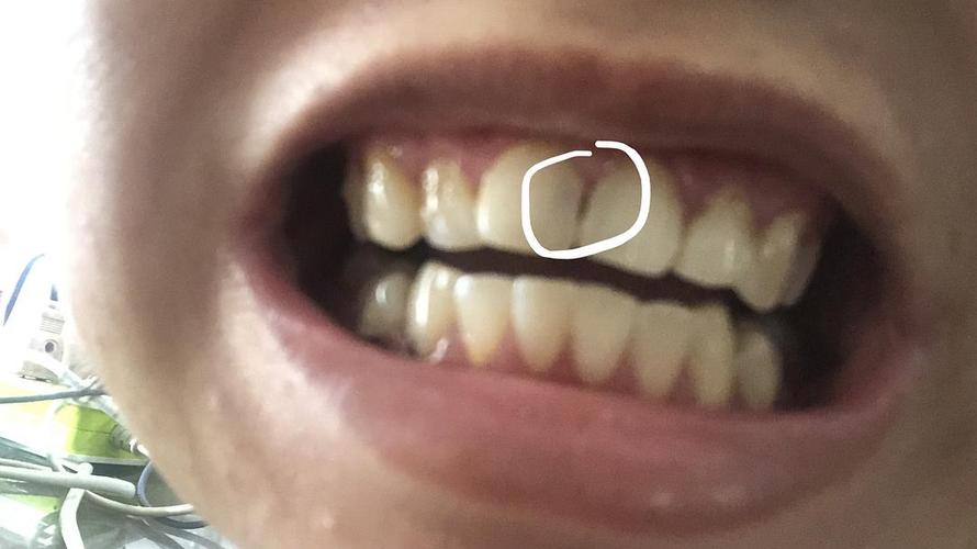 uus门牙中间有一条黑缝 这是蛀牙了吗(更新)