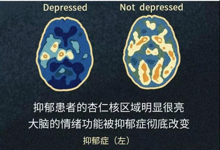 2,其次神经科学从脑神经递质来看也发现了抑郁症大脑和普通人不同的