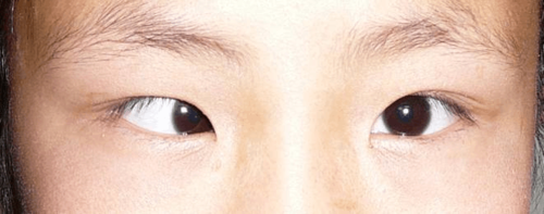 方法 斜视是儿童最常见的眼科疾病之一,位于儿童眼病患病率的第三位