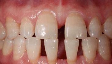 牙齿间的缝隙为什么会变大昌平正畸