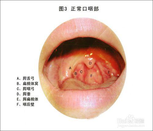 焦虑症喉咙堵的症状吗 焦虑症感觉喉咙堵怎么能缓解