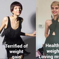 厌食症女孩骨瘦如柴,体重只有30公斤,如同一具行走的