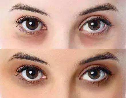你的黑眼圈是什么颜色不同原因导致的黑眼圈表现不同如何保养最有效