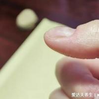 大拇指指甲凹陷图片与疾病不要惊慌多是缺铁性贫血4种情况