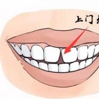 门牙中间有缝的面相命运解析牙齿中间有缝易漏财