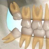 智齿为什么会出现牙洞