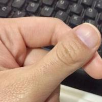大拇指指甲盖又宽又短弯曲90代表什么