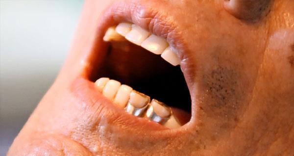 牙缝里抠出来的黄泥是什么?味道还很臭,是哪些原因导致的?