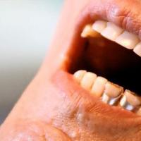 牙缝里抠出来的黄泥是什么?味道还很臭,是哪些原因导致的?